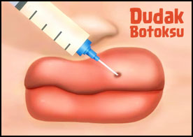 Dudakları iyi durumda olmayan mutsuz hastamızın dudaklarına botoksla dolgu yaparak güzelleştir